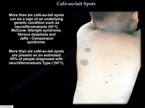 college babe gets cafe au laid|Cafe Au Lait Spots: Background, Pathophysiology, Etiology.